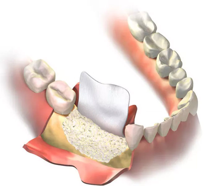 guided bone regeneration